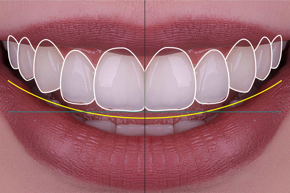 Smile design treatment and smile makeover